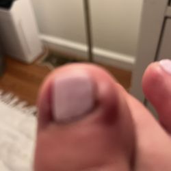 Infected toe after he insisted on taking my ingrown out