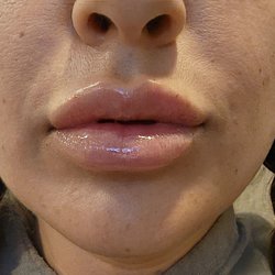 Reviv Med Spa - 1 day healed - 1 syringe Juvederm Ultra