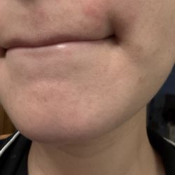 Zia Threading  - Razor like bumps...