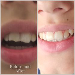 Elementary Smiles - Cheryl L Johnston DMD - Before and After