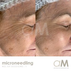 Arizona Microneedling - Anti-Aging Treatment