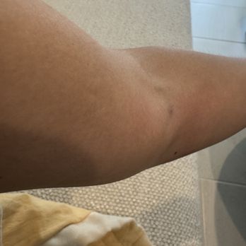 Quest Diagnostics - Swollen arm after blood draw at Quest Coral Springs!! - Laboratory Testing Near Me - Coral Springs, Florida Quest Diagnostics - Swollen arm after blood draw at Quest Coral Springs!! - Laboratory Testing Near Me - Coral Springs, Florida