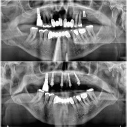 Luxor Dental - All On X
Teeth On Full Mouth Implants
All On 4 Dental Implants
