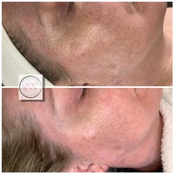 Wax Spa Studio - Before and after- Sensi Peel by PCA.