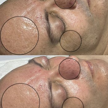 LX Aesthetics - I love me a good before and after - Skin Care Near Me - Tucson, Arizona LX Aesthetics - I love me a good before and after - Skin Care Near Me - Tucson, Arizona