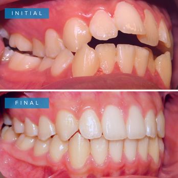 Holliday Orthodontics - Before and after - Orthodontists Near Me - Honolulu, Hawaii Holliday Orthodontics - Before and after - Orthodontists Near Me - Honolulu, Hawaii