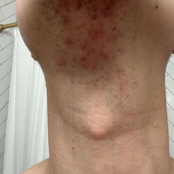 Eye Candy - Pimple outbreak 2 days after Laser Hair Removal Treatment. Chin area. Really bad and painful. - Eyelash Service Near Me - Buena Park, California