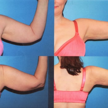 Ranch & Coast Plastic Surgery - Before liposuction on left, 4 weeks after on right - Medical Spas Near Me - Del Mar, California Ranch & Coast Plastic Surgery - Before liposuction on left, 4 weeks after on right - Medical Spas Near Me - Del Mar, California
