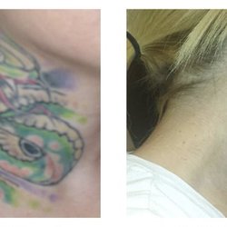 The Skyn Spa - Tattoo removal using PicoSure laser! Amazing results in the fewest amount of treatment!