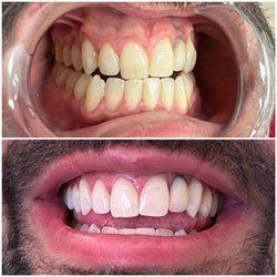 Beauty Box SF - LED Teeth Whitening