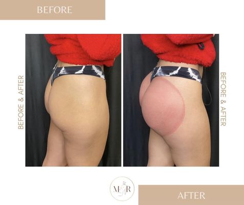 Butt Lifts - A butt lift session naturally lifts & firms butt, making it bigger and rounder. Each session is equivalent to 1,500 squats.  Butt Lifts - A butt lift session naturally lifts & firms butt, making it bigger and rounder. Each session is equivalent to 1,500 squats. 