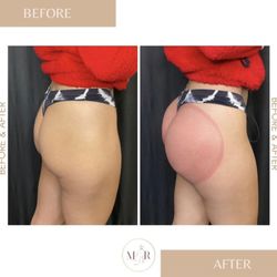 BeautybyMiaRose - Immediate before and after of 1 butt lift session.
