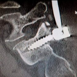 Gary S Shapiro MD - Chunks of the S1 vertebrae being pulled out by the loose screw