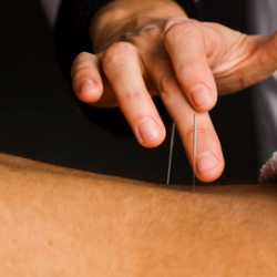 Reno Acupuncture - Acupuncture for Back Pain