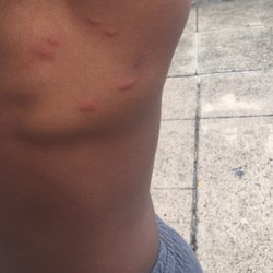 American Furniture Design - Bedbug bites from mattresses
