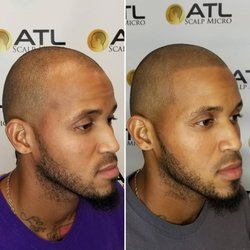 ATL Scalp Micro - Before and After Best Scalp Micropigmentation Black Hispanic Men Atlanta GA