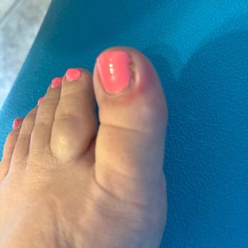 Le's Nails Hi - This is my swollen infected toe. - Nail Salons Near Me - Port Allen, Louisiana Le's Nails Hi - This is my swollen infected toe. - Nail Salons Near Me - Port Allen, Louisiana