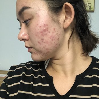 La Jolla Acne Specialists - October 9th, taken before first appointment - Acne Treatment Near Me - San Diego, California La Jolla Acne Specialists - October 9th, taken before first appointment - Acne Treatment Near Me - San Diego, California
