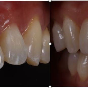 Ann Wei, DDS FACP - single central restorations- implant and crown - General Dentistry Near Me - San Francisco, California Ann Wei, DDS FACP - single central restorations- implant and crown - General Dentistry Near Me - San Francisco, California