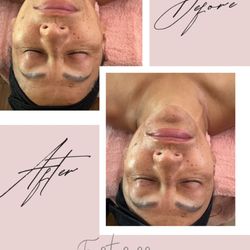 First session microdermabrasion.