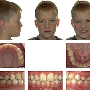 Guildford Orthodontic Centre - After - Orthodontists Near Me - Surrey, British Columbia