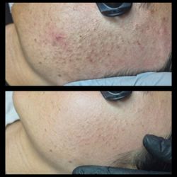 Hanis Spa - Before and after
