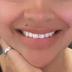 Gregory V. Keating, DMD - After my dental bonding appointment with Dr. Keating