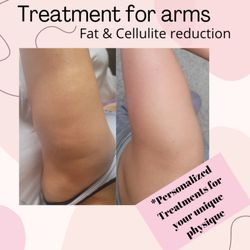 Active Body Sculpting