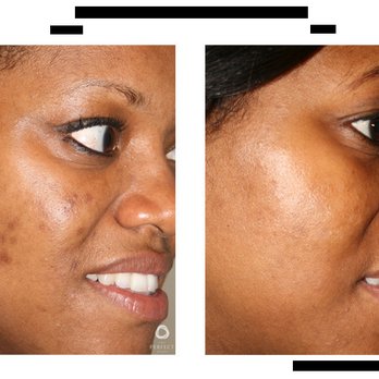 Skin Deep Laser Services - Tattoo Removal Near Me - Burke, Virginia Skin Deep Laser Services - Tattoo Removal Near Me - Burke, Virginia