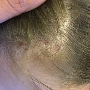 Zolf Salon - This is in the front of my head the burns are pretty visible - Hair Stylists Near Me - San Ramon, California
