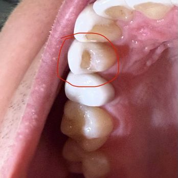 Luxe Dental Cosmetics - Broken veneer -- a veneer that broke after installation - General Dentistry Near Me - Los Angeles, California Luxe Dental Cosmetics - Broken veneer -- a veneer that broke after installation - General Dentistry Near Me - Los Angeles, California