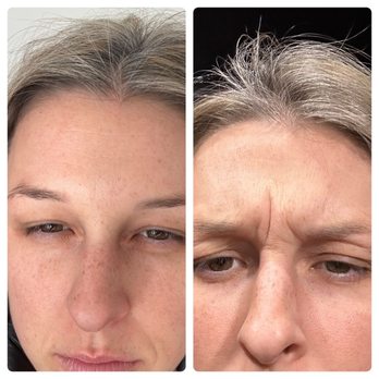 NakedMD - 7 day results - Medical Spas Near Me - Mission Viejo, California