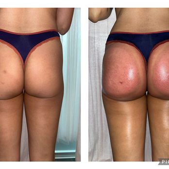 Glynis Aesthetics - Body Contouring Near Me - Bellevue, Washington Glynis Aesthetics - Body Contouring Near Me - Bellevue, Washington