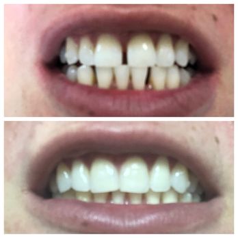 George Abed Orthodontics - Before/After - Orthodontists Near Me - Arcadia, California George Abed Orthodontics - Before/After - Orthodontists Near Me - Arcadia, California