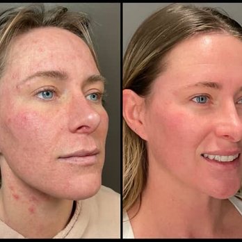 Auri Aesthetics | Premier Medspa - Before and after skin treatment (micro-needling & ZO Skin Health products) - Medical Spas Near Me - Gilbert, Arizona