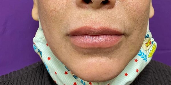 Before and after Full Lip Color - This client left my office with beautiful Lip Color! Before and after Full Lip Color - This client left my office with beautiful Lip Color!