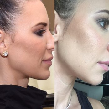 Marina's Oasis Medical Aesthetics - Before and after of my jawline. Marina used Voluma XC to smooth it out and make it look more defined. - Skin Care Near Me - Pasadena, California Marina's Oasis Medical Aesthetics - Before and after of my jawline. Marina used Voluma XC to smooth it out and make it look more defined. - Skin Care Near Me - Pasadena, California