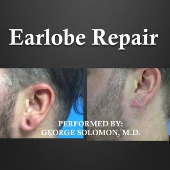Solomon Cosmetic Center - Earlobe repair from gages - Cosmetic Surgeons Near Me - Clearwater, Florida Solomon Cosmetic Center - Earlobe repair from gages - Cosmetic Surgeons Near Me - Clearwater, Florida