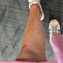 Bad spray tan