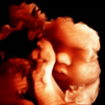 Stork Vision Madison - 4D HD Live baby during one of our Deluxe packages! - Ultrasound Imaging Centers Near Me - Madison, Wisconsin Stork Vision Madison - 4D HD Live baby during one of our Deluxe packages! - Ultrasound Imaging Centers Near Me - Madison, Wisconsin