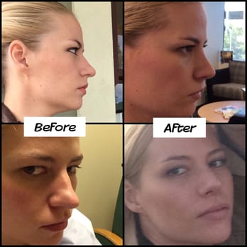 John R. Griffin, M.D - My before and after nose job. It is only 6 months later and it's perfect! I highly recommend Dr. Griffin for rhinoplasty. - Plastic Surgeons Near Me - San Mateo, California John R. Griffin, M.D - My before and after nose job. It is only 6 months later and it's perfect! I highly recommend Dr. Griffin for rhinoplasty. - Plastic Surgeons Near Me - San Mateo, California