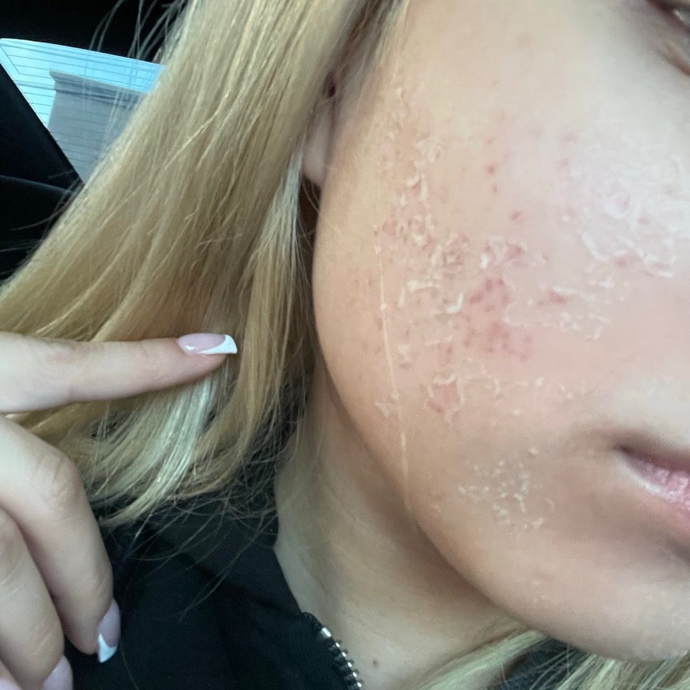 Barrett Plastic Surgery - peeling after zo 3 step peel - Cosmetic Surgeons Near Me - Beverly Hills, California Barrett Plastic Surgery - peeling after zo 3 step peel - Cosmetic Surgeons Near Me - Beverly Hills, California