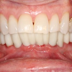 Synergy Dental Specialists - Beautiful full lower set of teeth supported by implants.