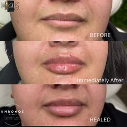 Khronos MedSpa - Love my lips!