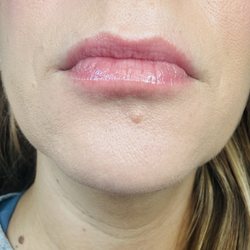 Vitality Health & Wellness, LLC - One week after a lip flip! Results  aren't even complete until week 2, but I love it already!