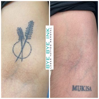 Bye Bye Ink - Goodbye! - Tattoo Removal Near Me - Middle Village, New York Bye Bye Ink - Goodbye! - Tattoo Removal Near Me - Middle Village, New York