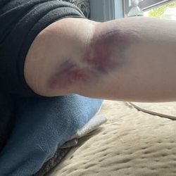 Labcorp - Bruise