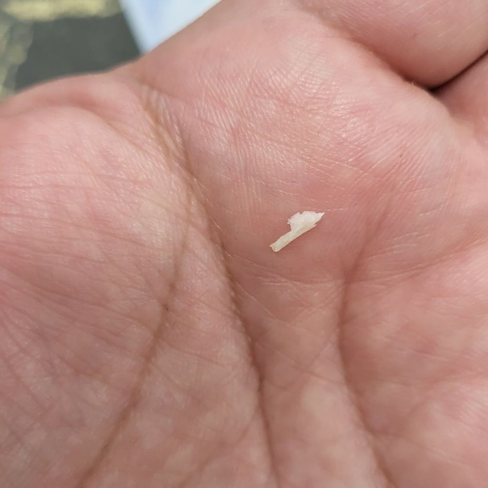 Da Vi Nails - Ingrown toenail. - Nail Salons Near Me - Las Cruces, New Mexico