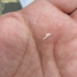 Da Vi Nails - Ingrown toenail.