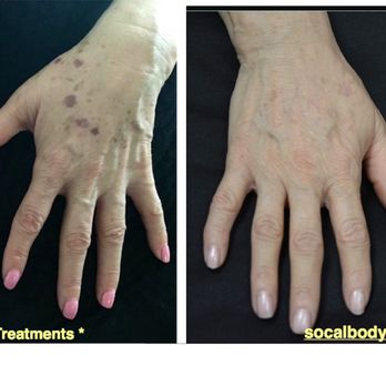 So Cal Body Institute - Before and after picture of dark spot removal on hands! We combined a home regimen with our PicoSure laser to get these results! - Tattoo Removal Near Me - Chino, California So Cal Body Institute - Before and after picture of dark spot removal on hands! We combined a home regimen with our PicoSure laser to get these results! - Tattoo Removal Near Me - Chino, California